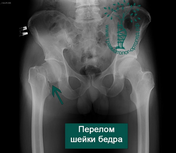 Почему перелом шейки бедра может быть смертельным